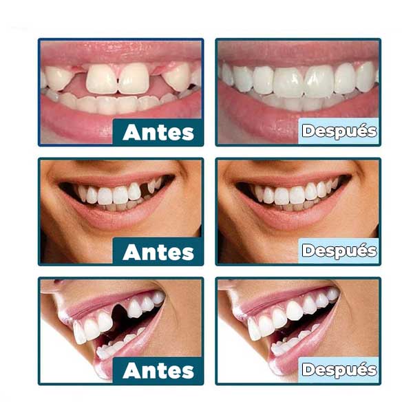 Sonrisa Pro® - Carillas Dentales Removibles (Superior + Inferior)